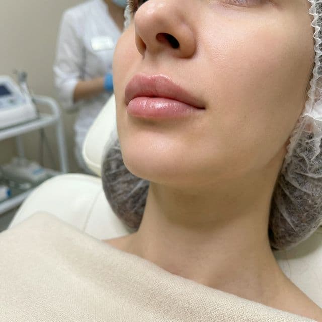 Natural lip enhancement